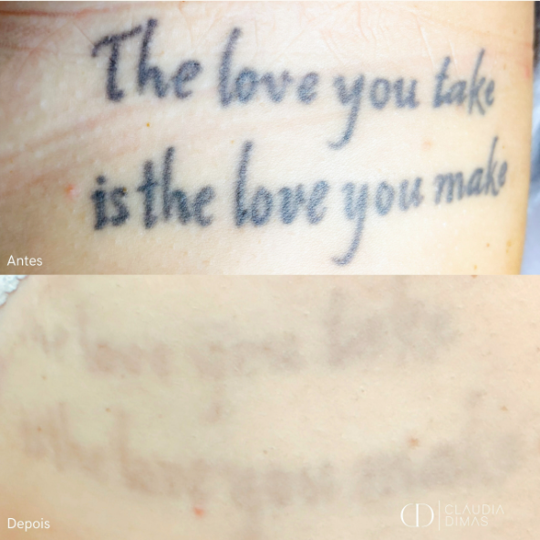 Remoção de tatuagem