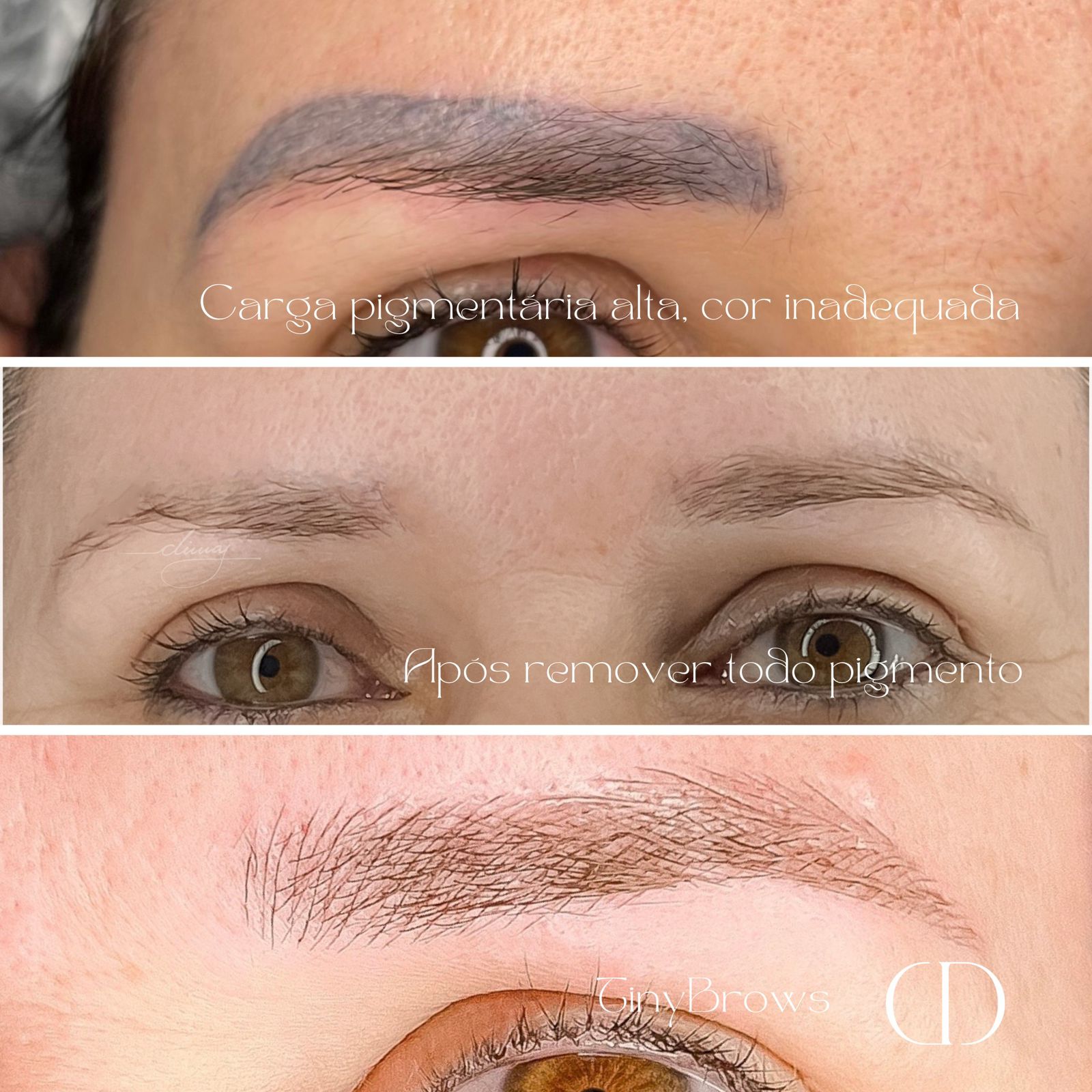 Remoção a laser e Dermafios