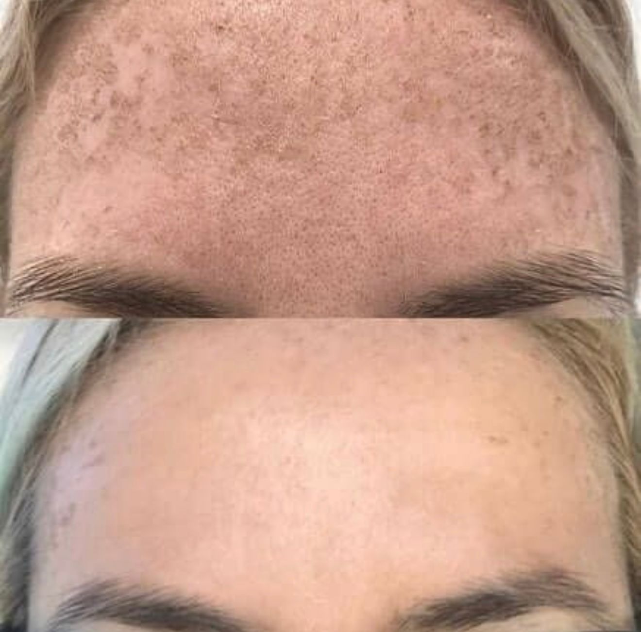 Tratamento para melasma