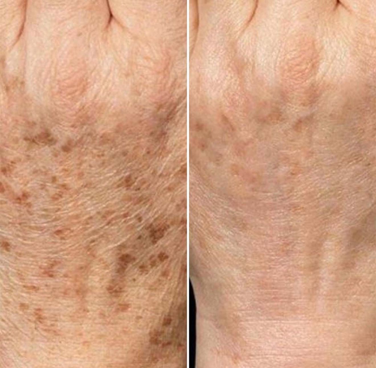 Tratamento para melasma